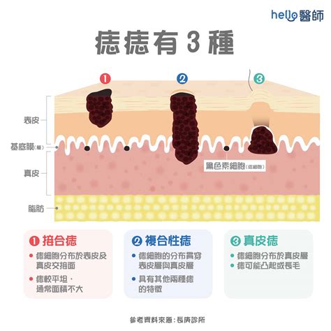 痣長毛原因